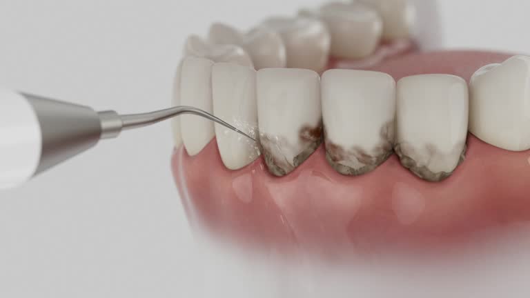 Trusted Wisdom Tooth Removal service in Fairview Park, OH - Dentist Open Now
